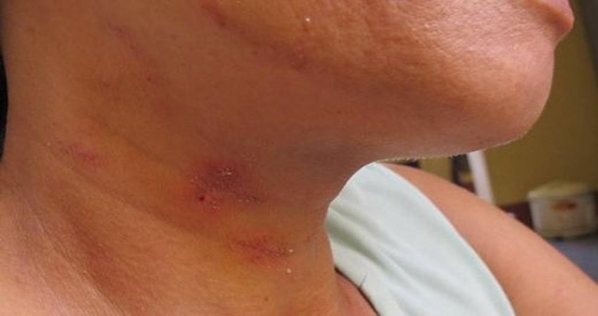 Tác hại khi bị kiến ba khoang đốt