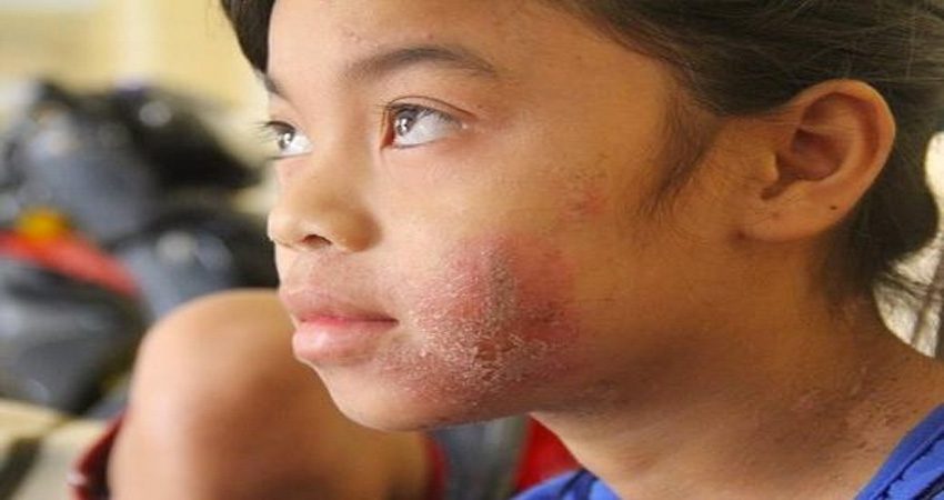 vết đốt của kiến ba khoang