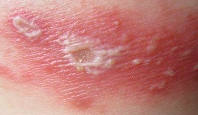 Tác hại của kiến ba khoang